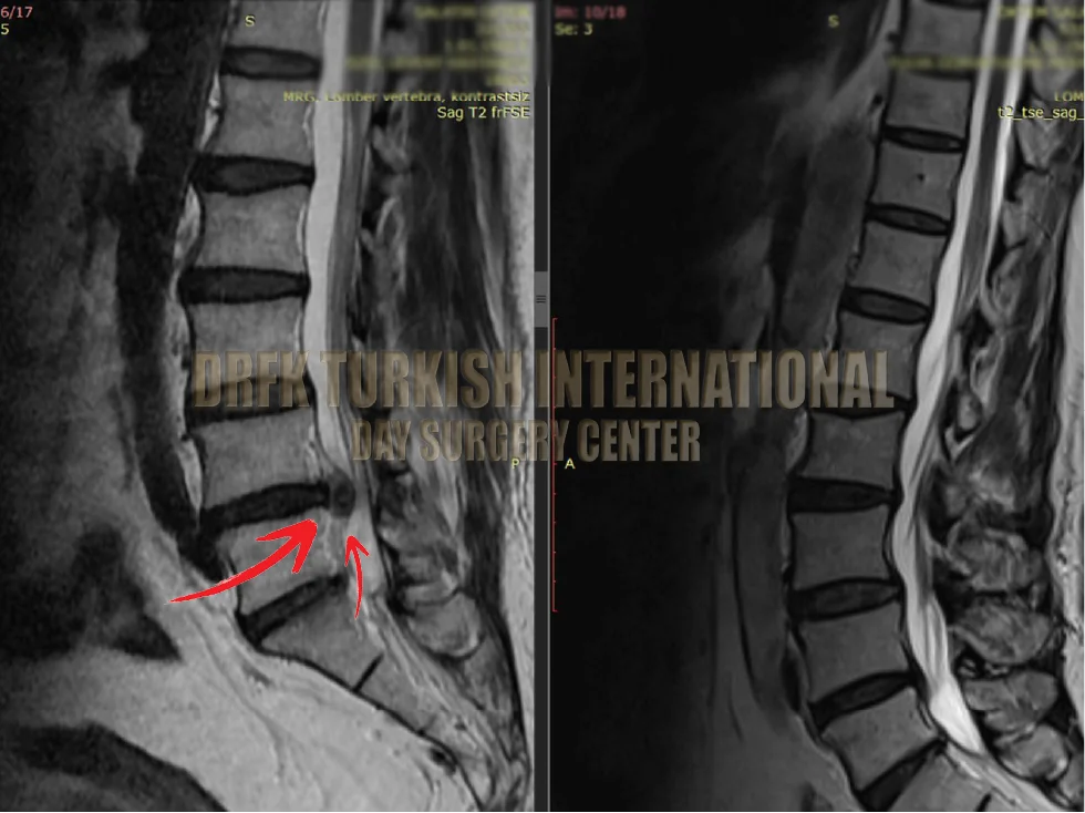Hernia before after result 1