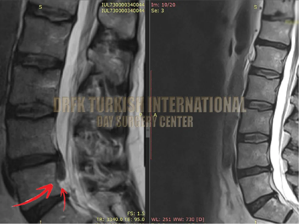 Hernia before after result 2