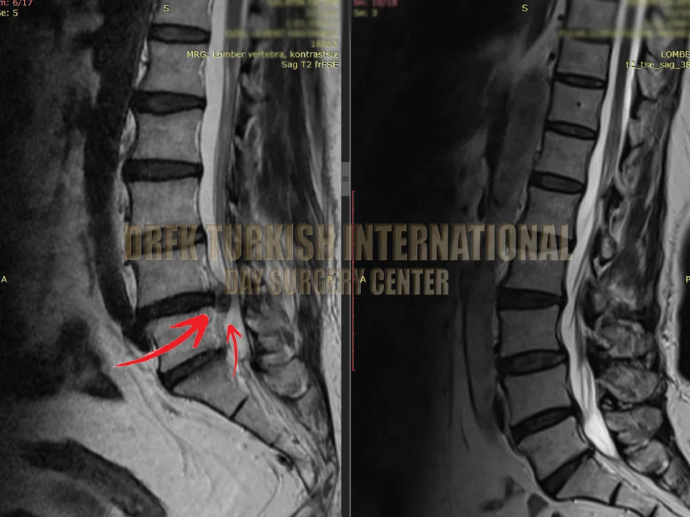 Hernia before after result 3