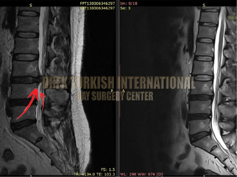 Hernia before after result 4