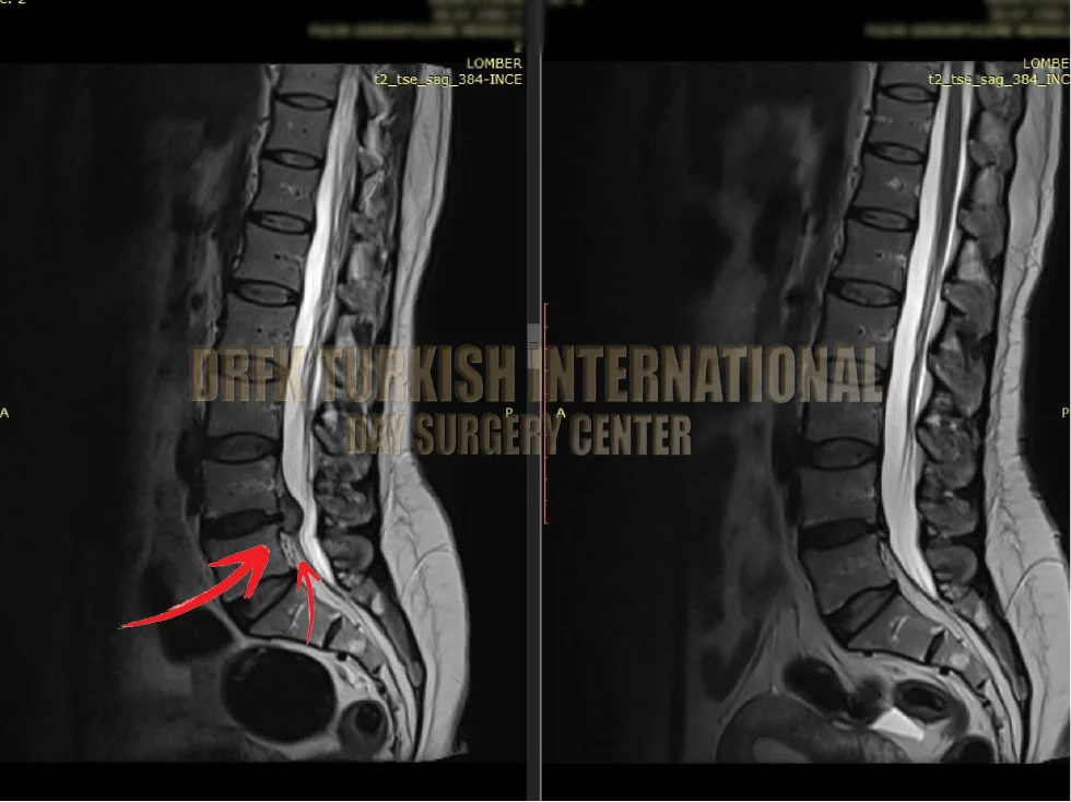Hernia before after result 5