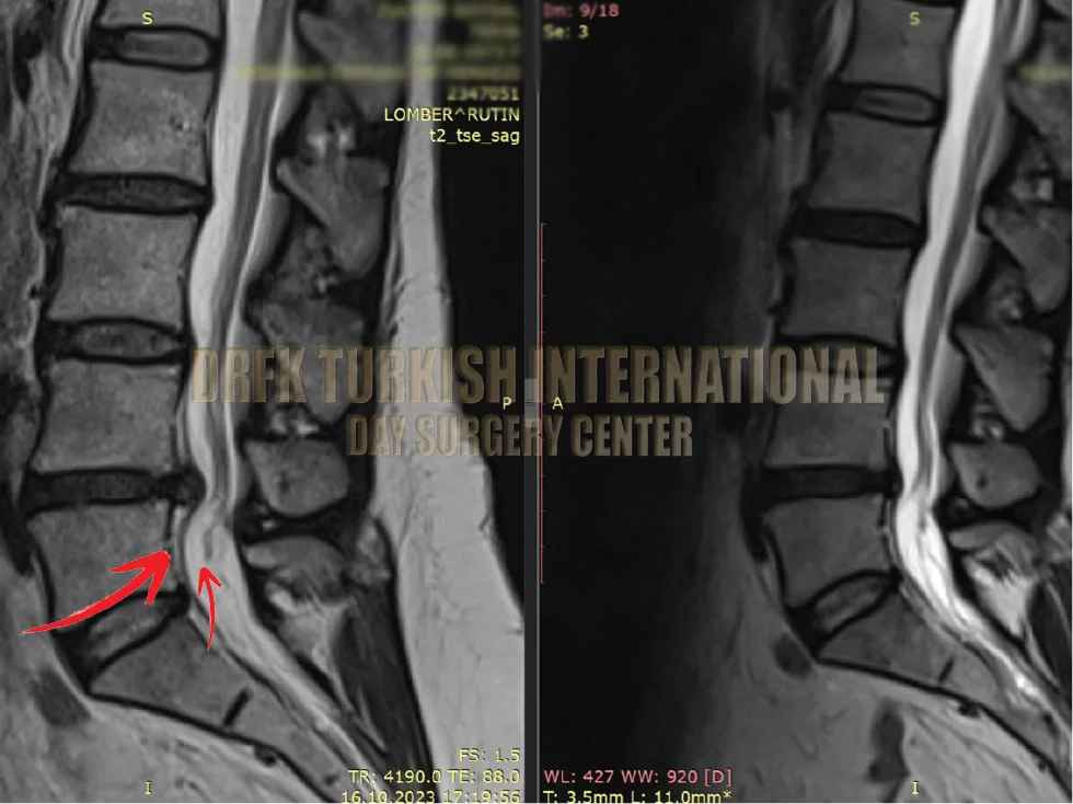 Hernia before after result 6
