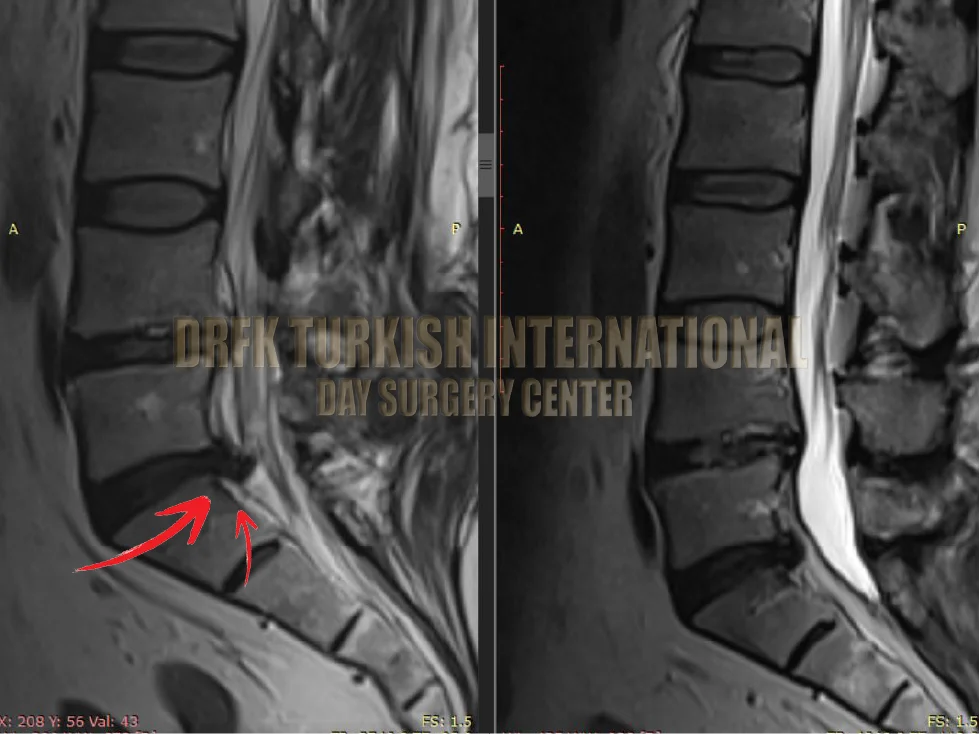 Hernia before after result 7