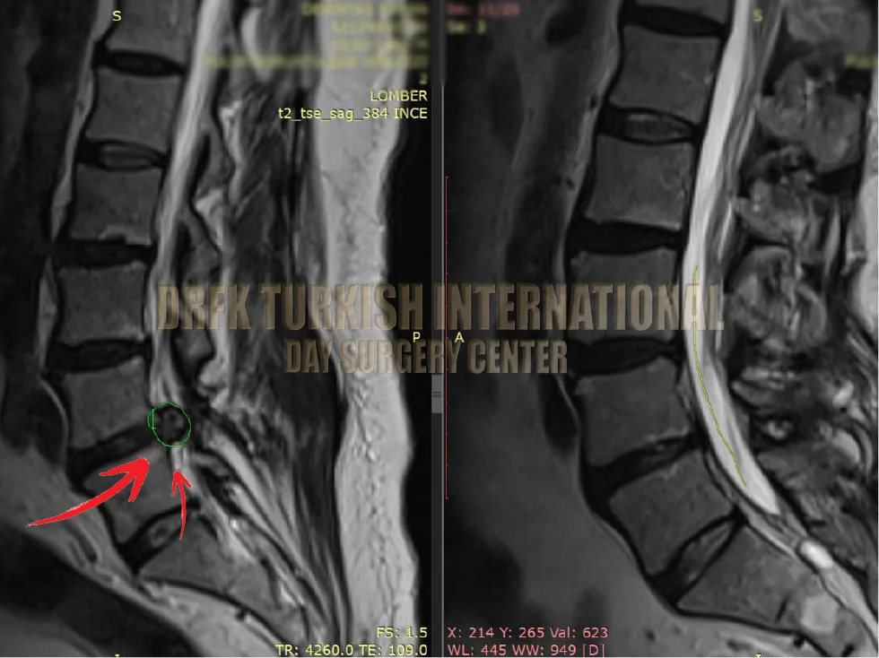 Hernia before after result 8