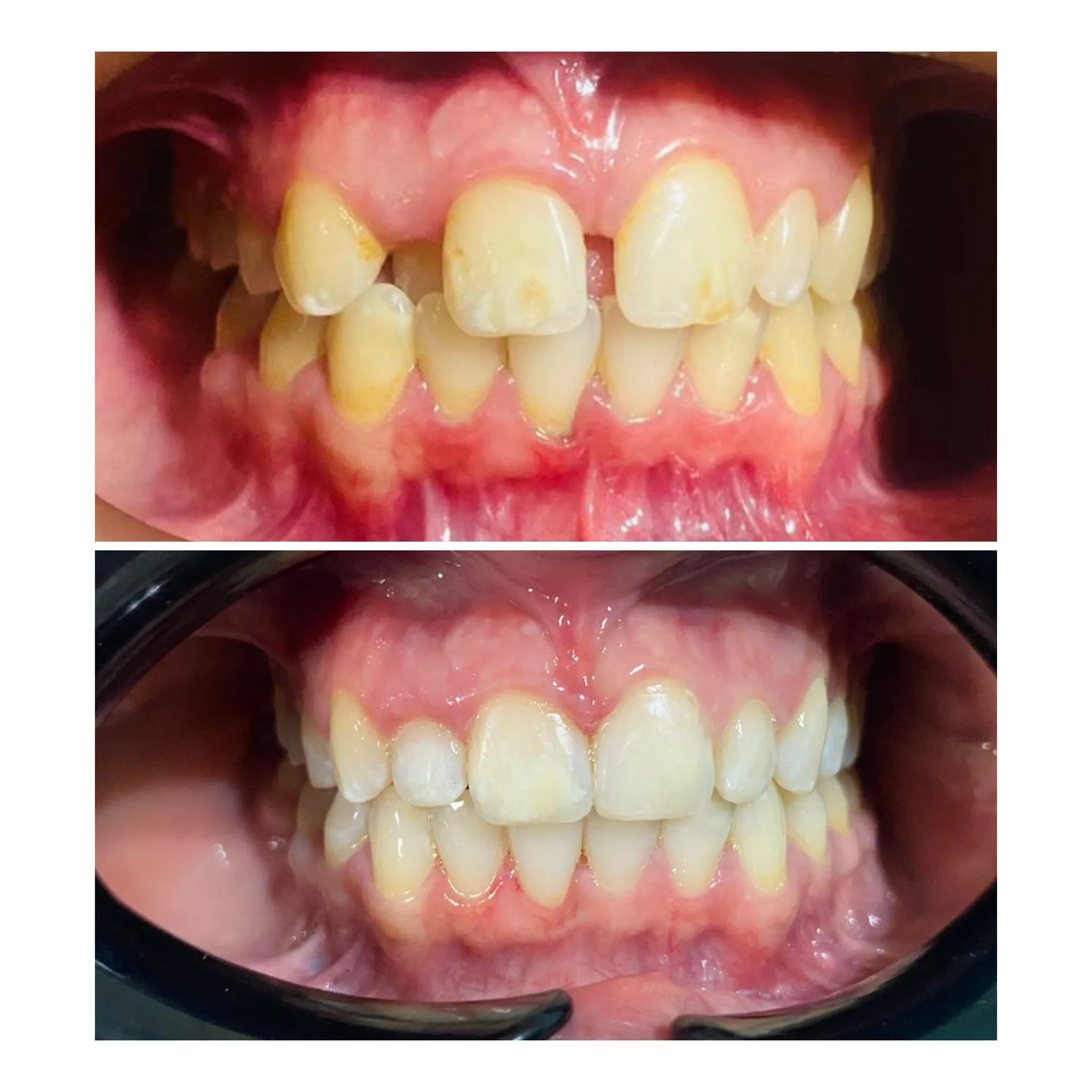 Dental Treatment Result 1